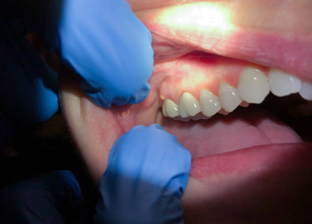 Best Emergency Dental Extractions in Gaston, SC