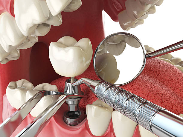 Best Emergency Dentist for Lost Fillings or Crowns in Gaston, SC